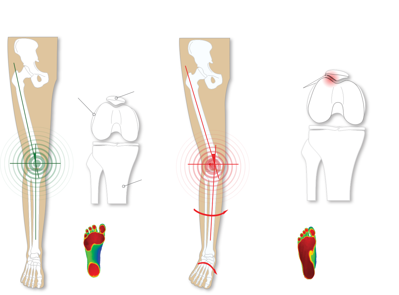 overpronation-knee-pain