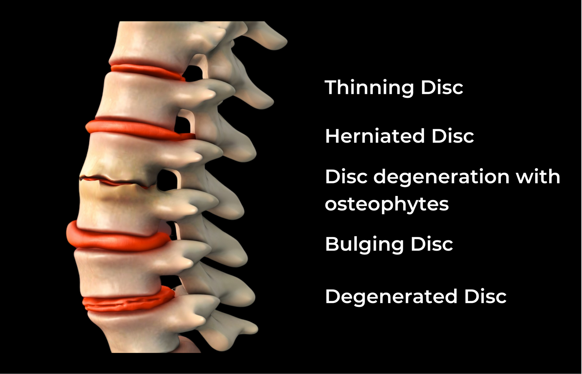 Disk injuries that Spinal Decompression can help