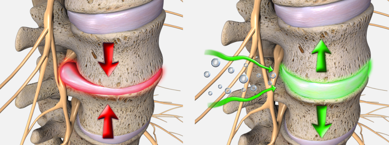 spinal decompression reduces pain and inflammation by decreasing pressure on the discs.