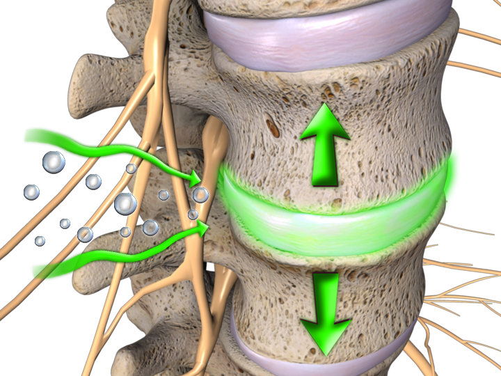 spinal decompression reduces inflammation by relieving pressure on the discs.