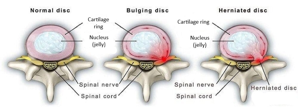 spinal decompression can help with bulging or herniated disc injuries.