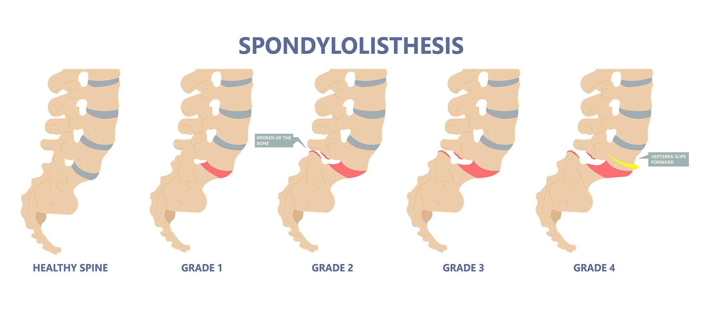 spinal decompression can help with Spondylolisthesis