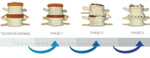 spinal decompression can help with spinal degeneration.