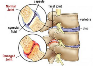 spinal decompression can help with facet syndrome.