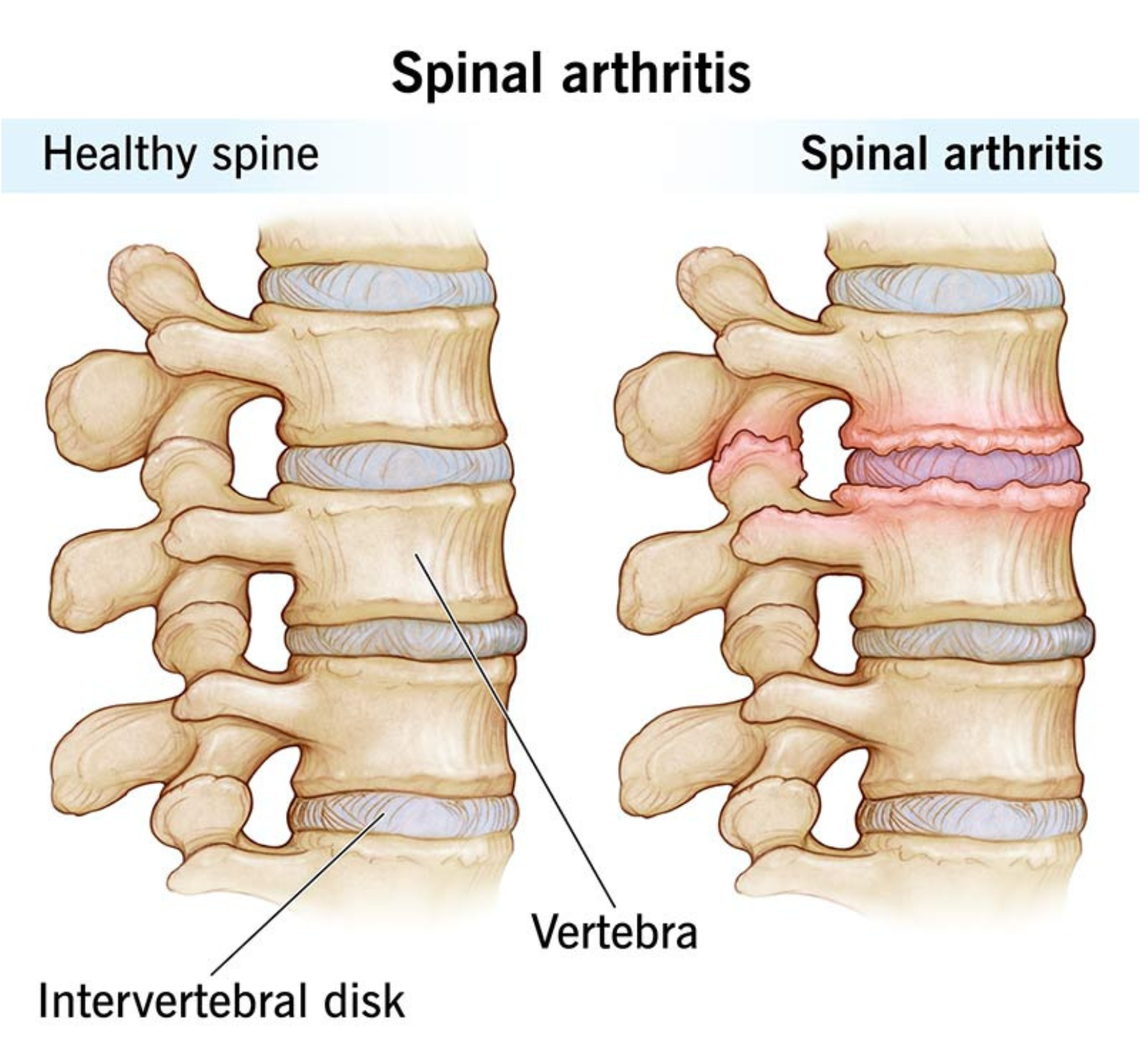 spinal arthritis