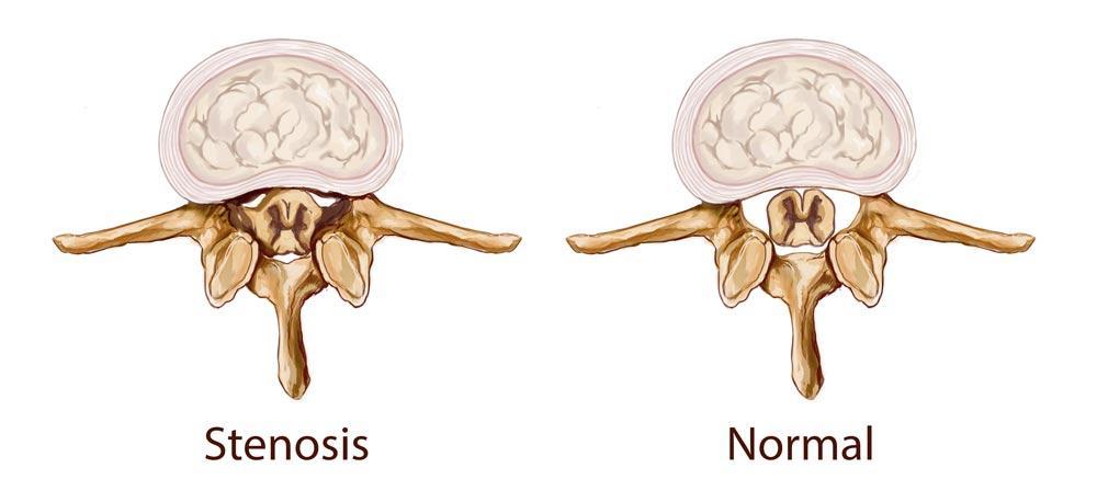 spinal decompression can help with spinal stenosis