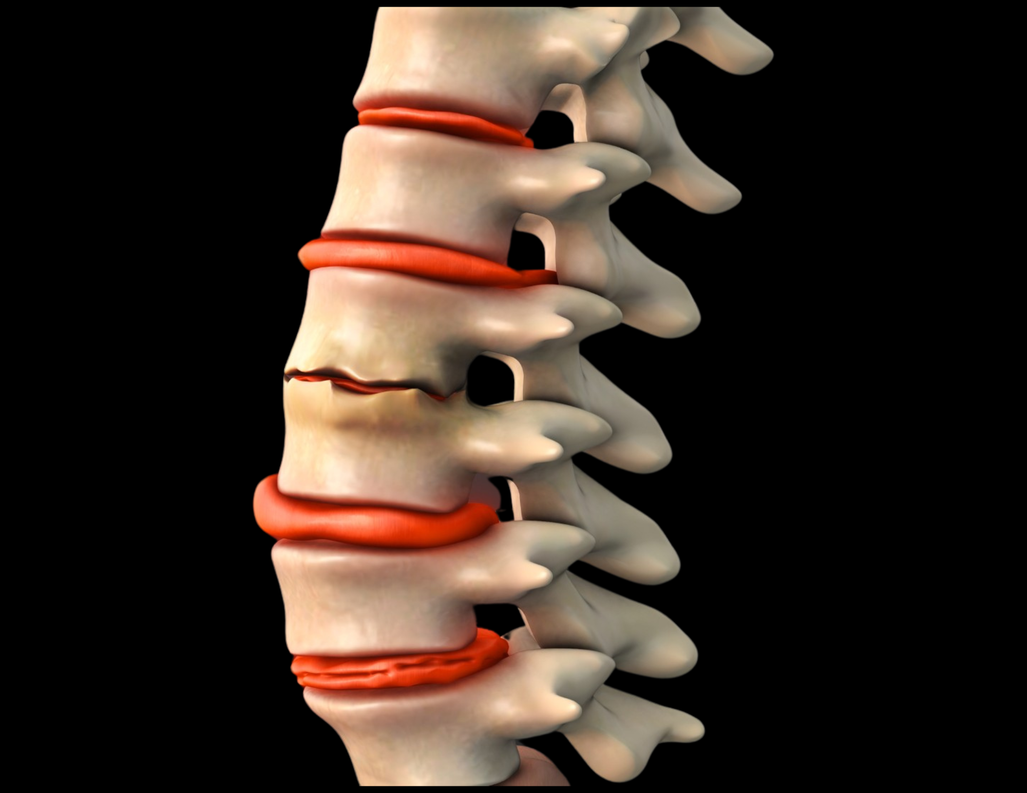 spinal decompression can help with spine decay and disc issues.